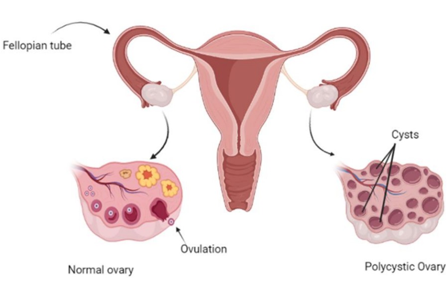 PCOS and Irregular Ovulation